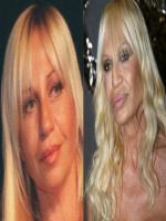 Donatella Versace Before and After Plastic Surgery