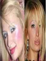 Paris Hilton Before and After Plastic Surgery