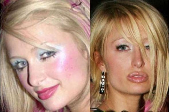 Paris Hilton Before and After Plastic Surgery