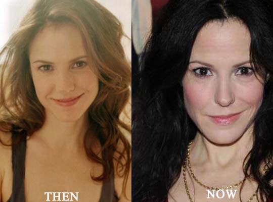 Mary-Louise Parker Plastic Surgery