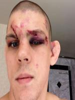 Joe Lauzon After Hard Match