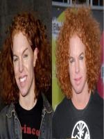 Scott Carrot Top Thompson Before and After Plastic Surgery