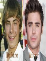 Zac Efron Nose Job Before and After