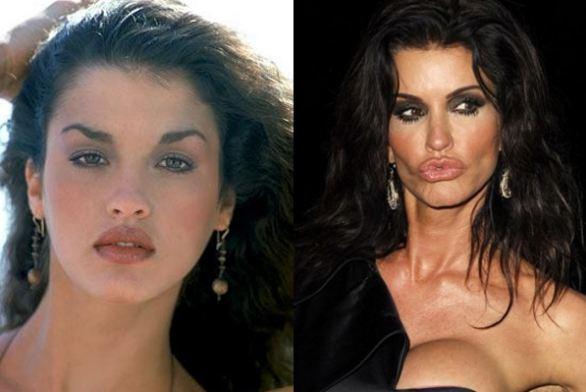 Janice Dickinson Before and After Plastic Surgery