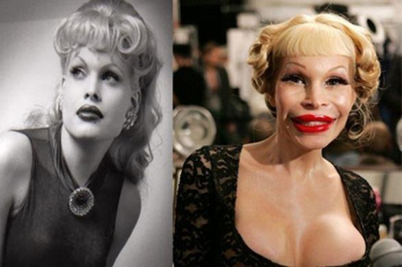 Amanda Lepore Before and After Plastic Surgery