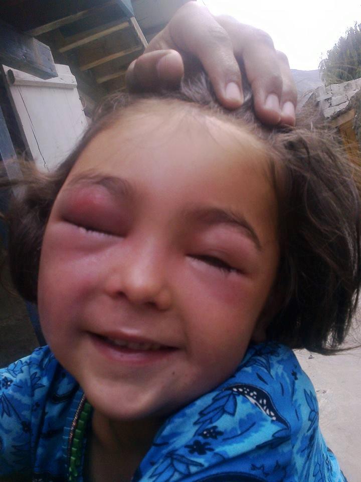 Bee Bit a Little Girl on her Face